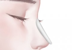 塌鼻子的成功人士有嗎？隆鼻多少錢(qián)？美鼻攻略必看！
